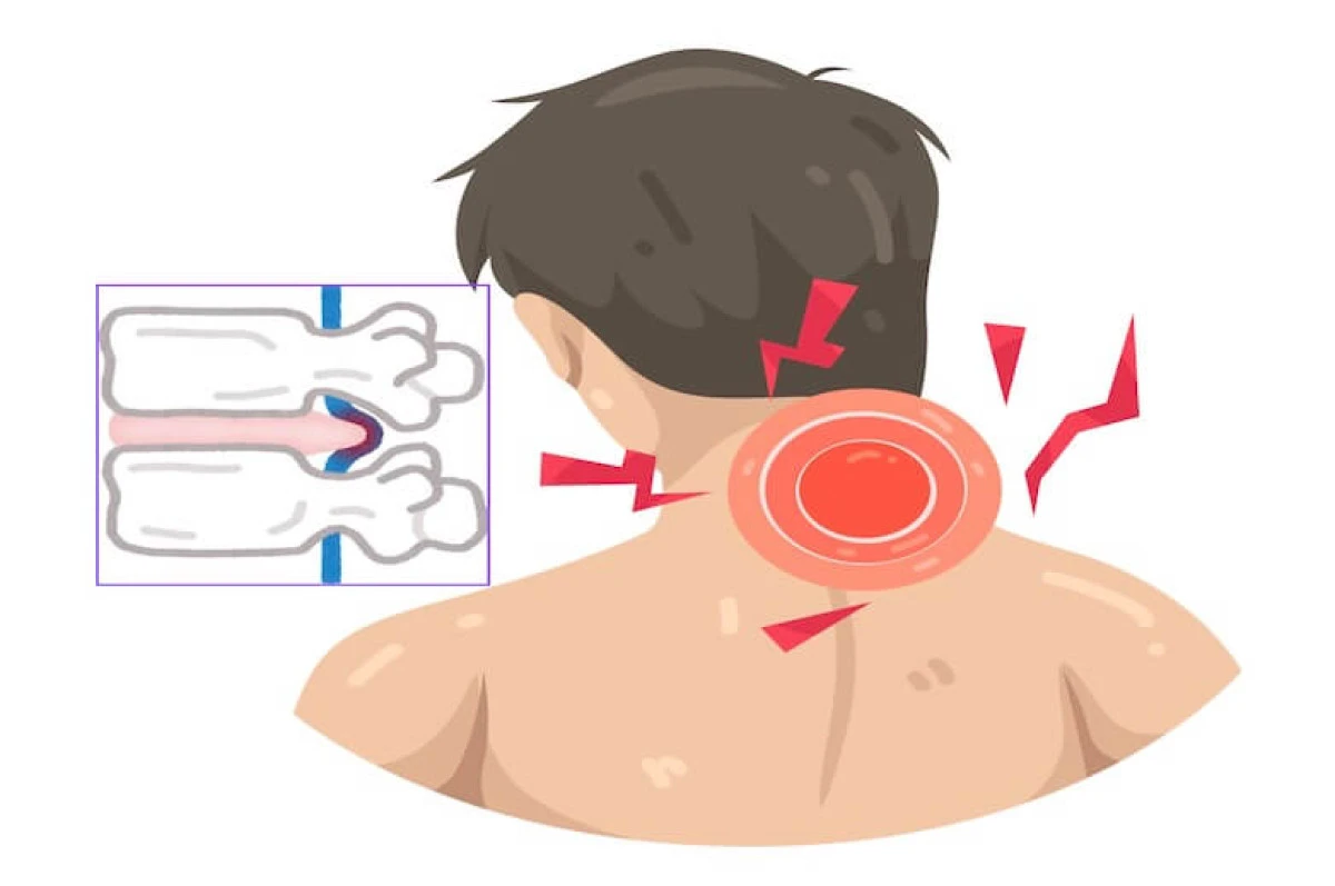 Boyun Fıtığı Ameliyatı Ne Zaman Gerekir? Ağrı Nereye Vurur ve Her Fıtık Ağrı Yapar mı?